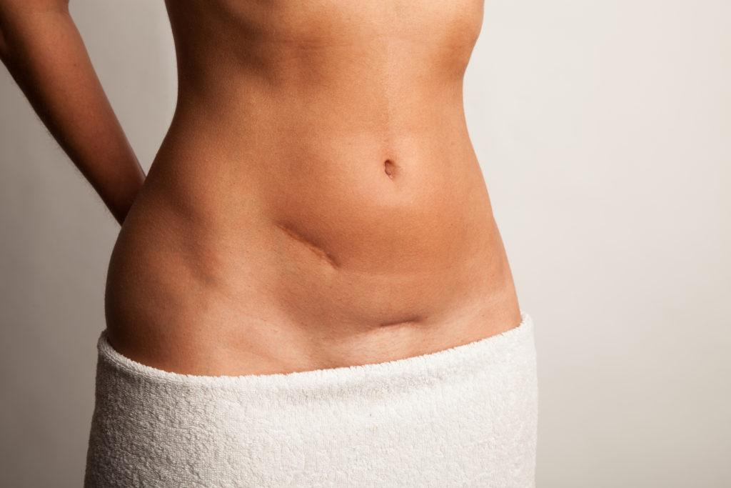 A woman's midsection, she has incision scars on her belly from hernia repair surgery in Houston, TX 