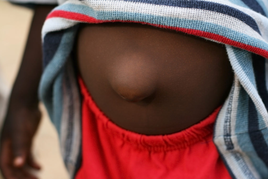 An image of a little boys inflamed stomach, the child's belly button is swollen and poking out because of a hernia.